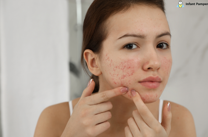 Postpartum Acne
